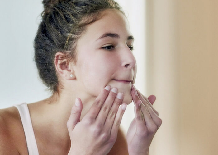What every teenager should know about pimples6